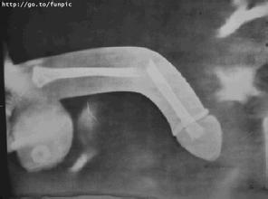 男子因老婆连生两女孩竟然挥刀自宫 阴茎断了能再接上吗?