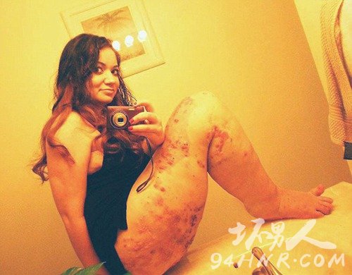 美女孩患罕见病 左腿异常肿胀是右腿三倍