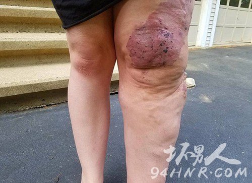 美女孩患罕见病 左腿异常肿胀是右腿三倍