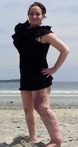 美女孩患罕见病 左腿异常肿胀是右腿三倍