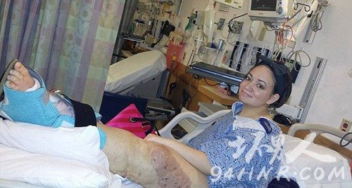 美女孩患罕见病 左腿异常肿胀是右腿三倍