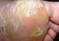 得了脚气怎么办_脚气的原因是什么_怎么治疗脚气