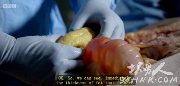 过度肥胖尸体解剖现场图片