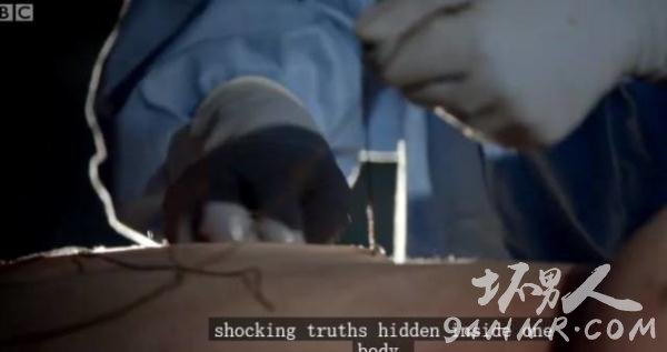 过度肥胖尸体解剖现场图片