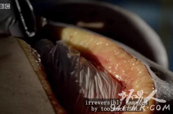 过度肥胖尸体解剖现场图片