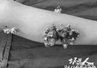 男孩身上长珊瑚 恐怖珊瑚男孩